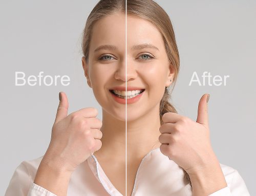Why Get a Smile Makeover