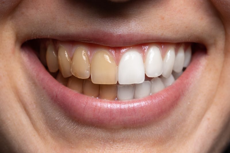 close up of mans teeth half stained half whitened