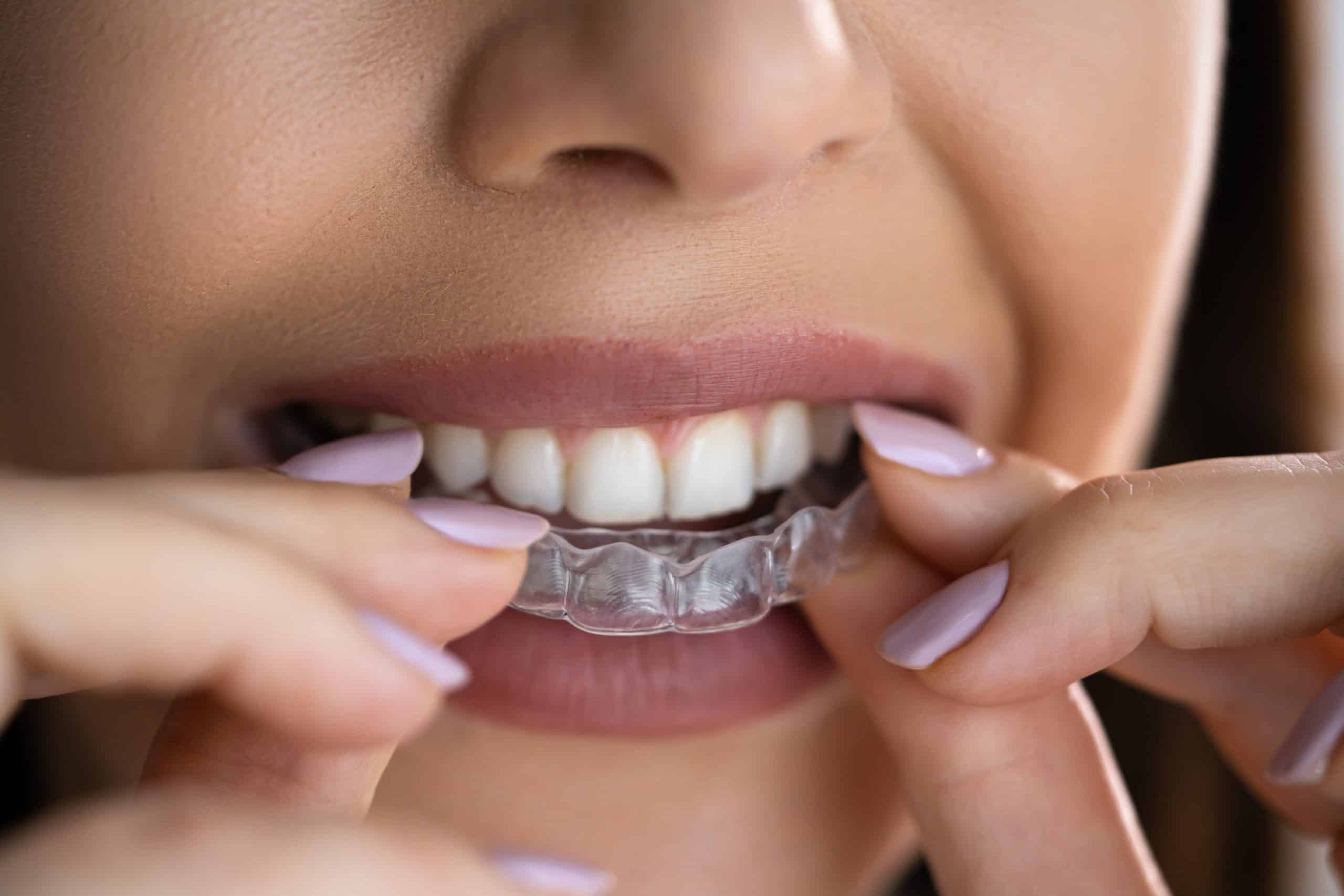 Woman putting on clear aligners onto top teeth