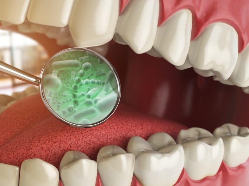 open mouth with dental mirror showing green bacteria