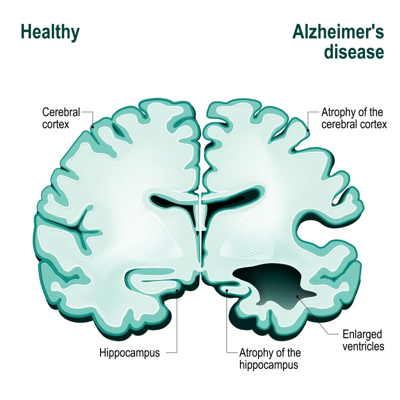 illustration of a brain half healthy and the other half with alzheimer’s 