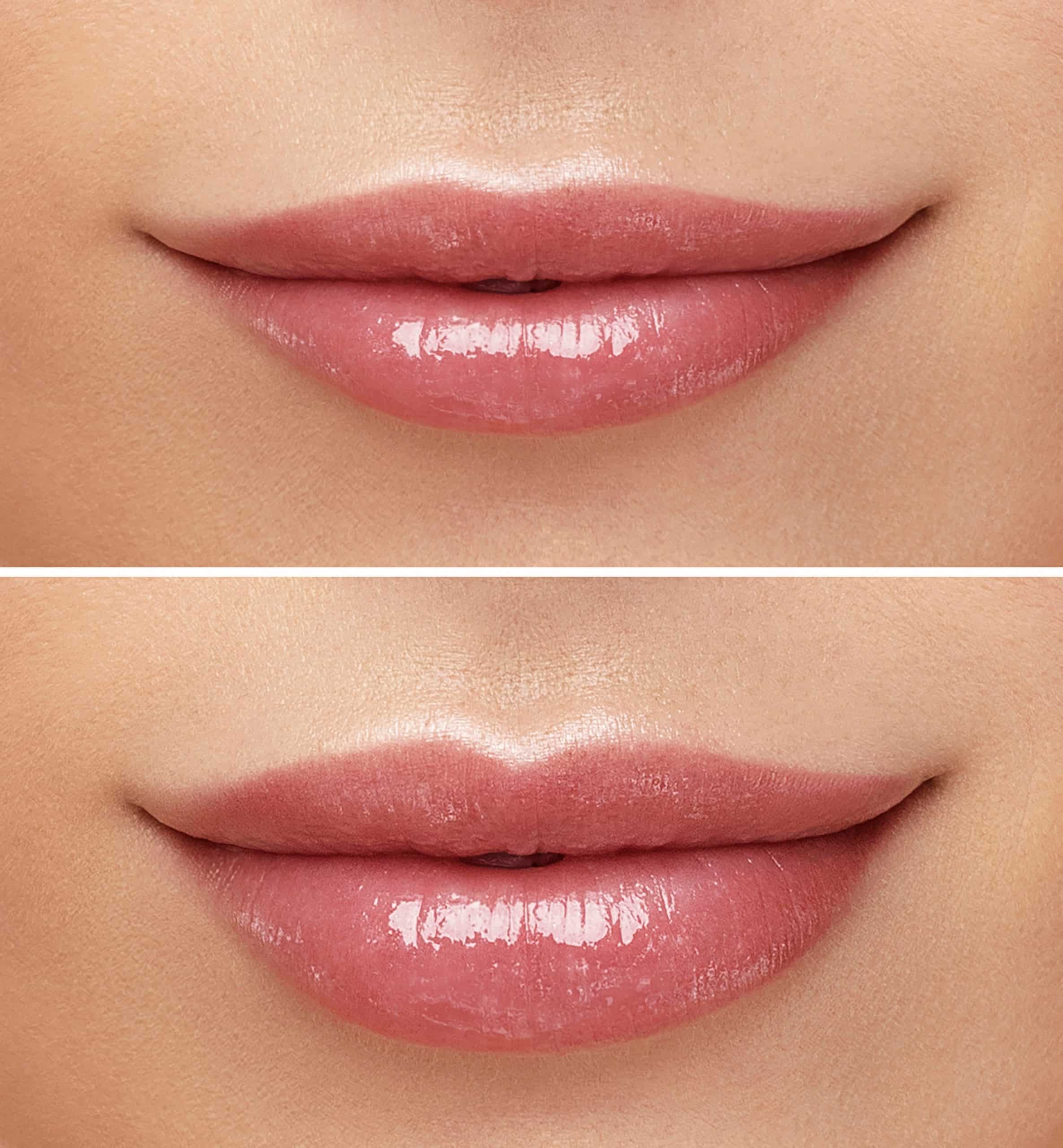 Before and after lip augmentation 