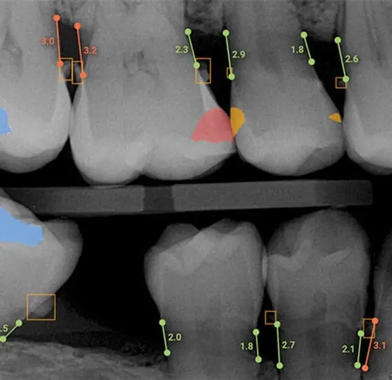Artificial intelligence software analyzing a dental X-ray