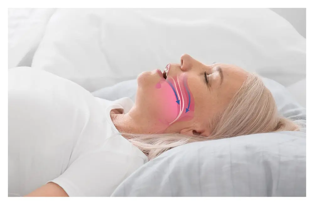 Illustration showing airflow changes during obstructive sleep apnea