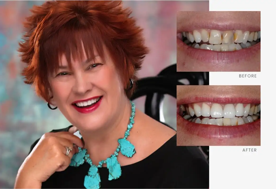 Stonebriar Smile Design patient case 1, before and after