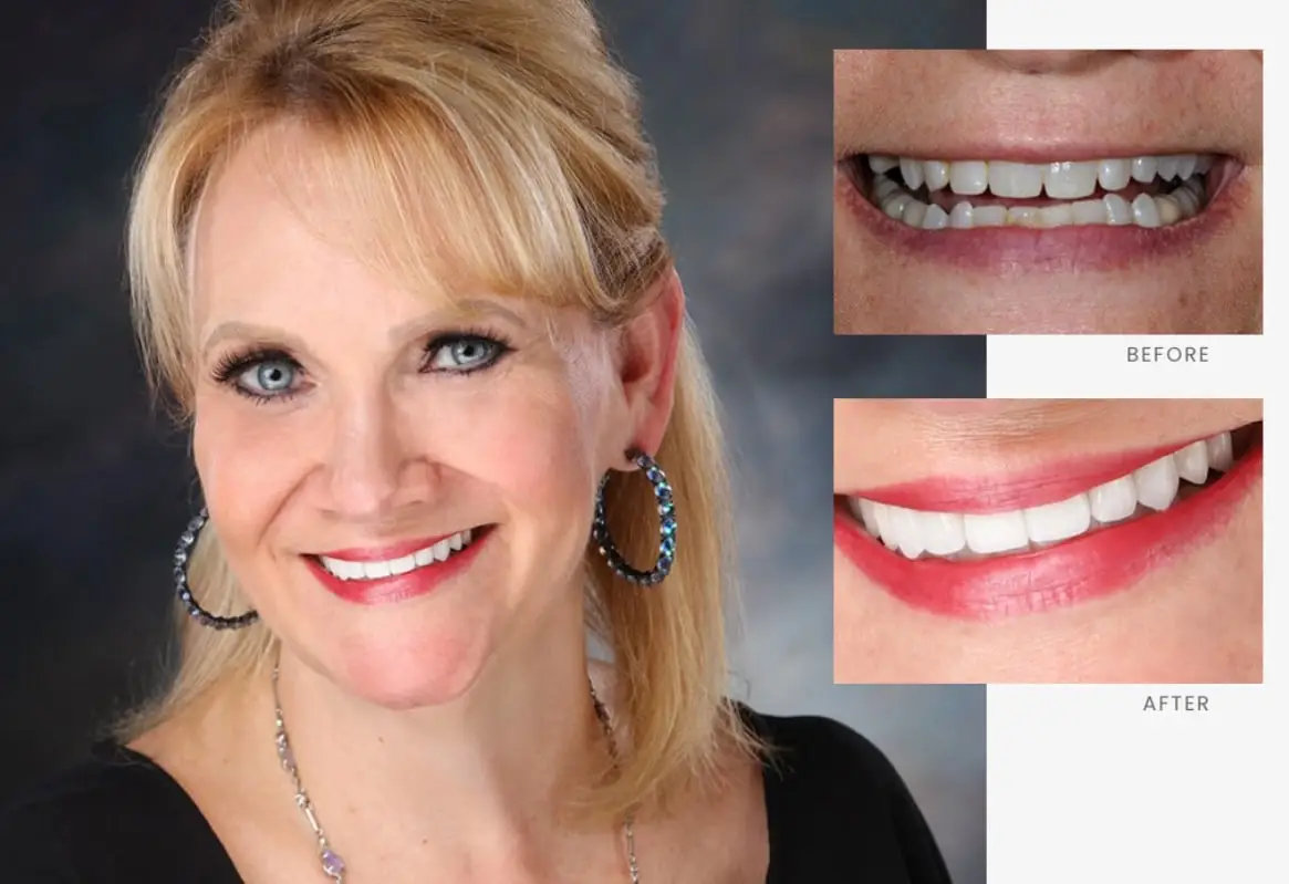 Stonebriar Smile Design patient case 10, before and after