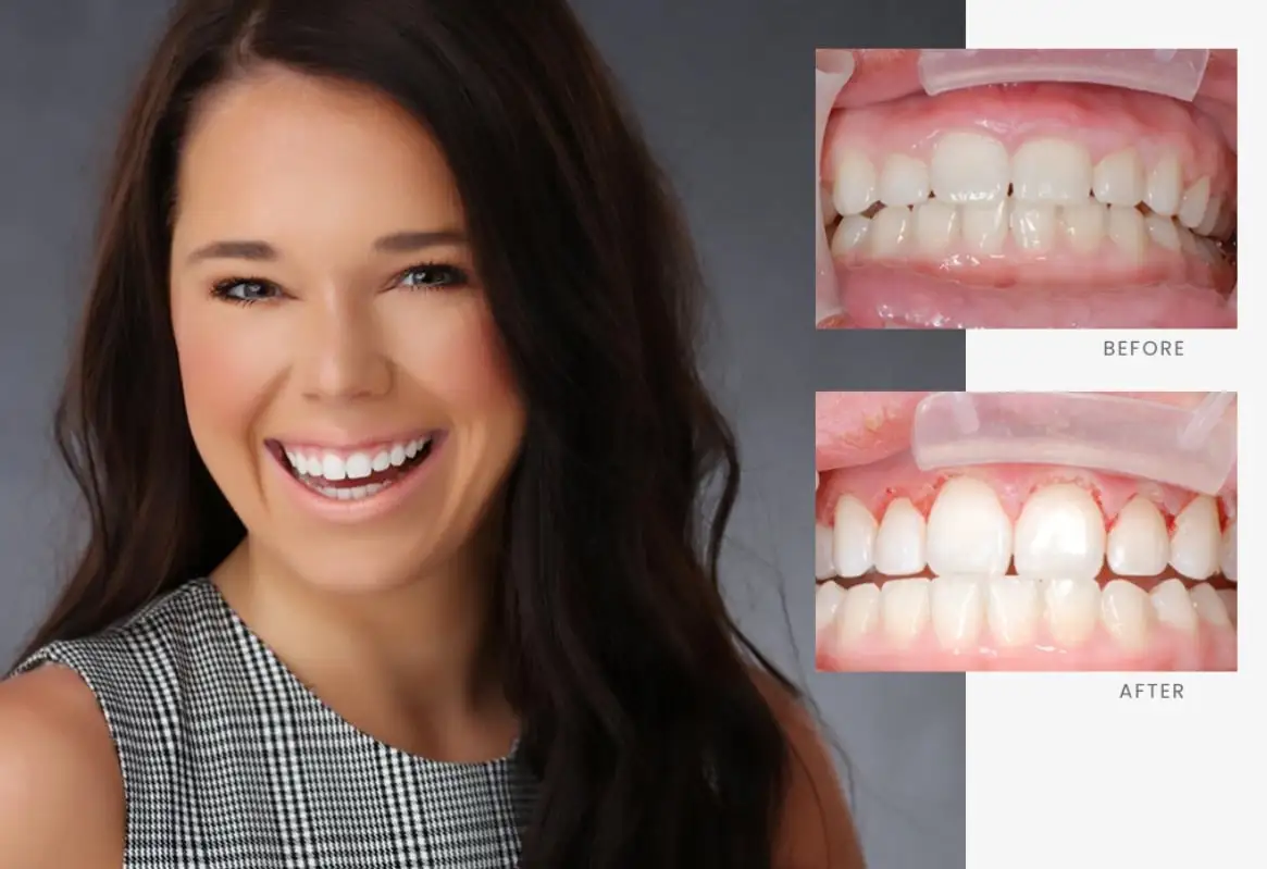 Stonebriar Smile Design patient case 12, before and after