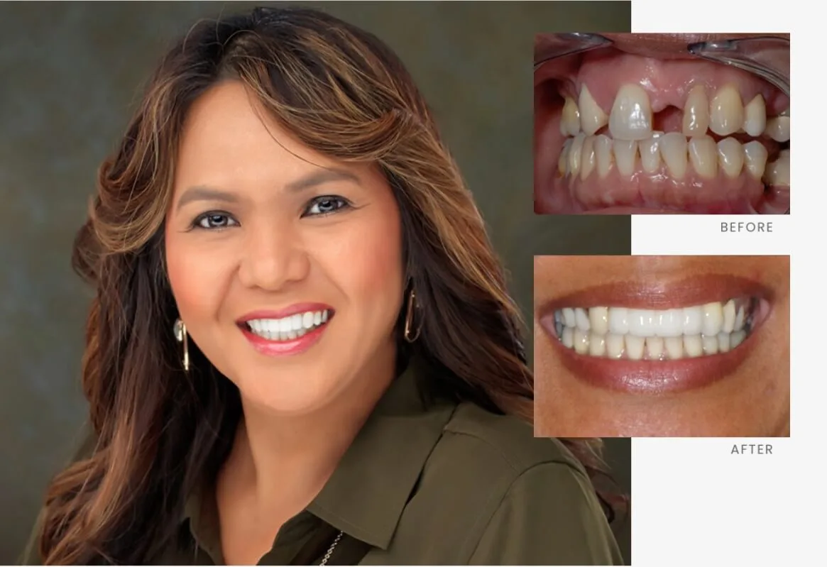 Stonebriar Smile Design patient case 2, before and after