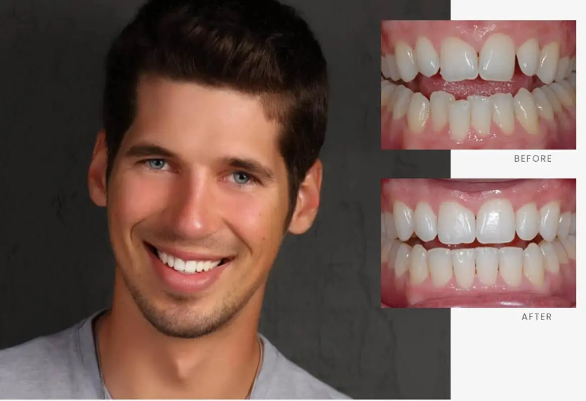 Stonebriar Smile Design patient case 3, before and after