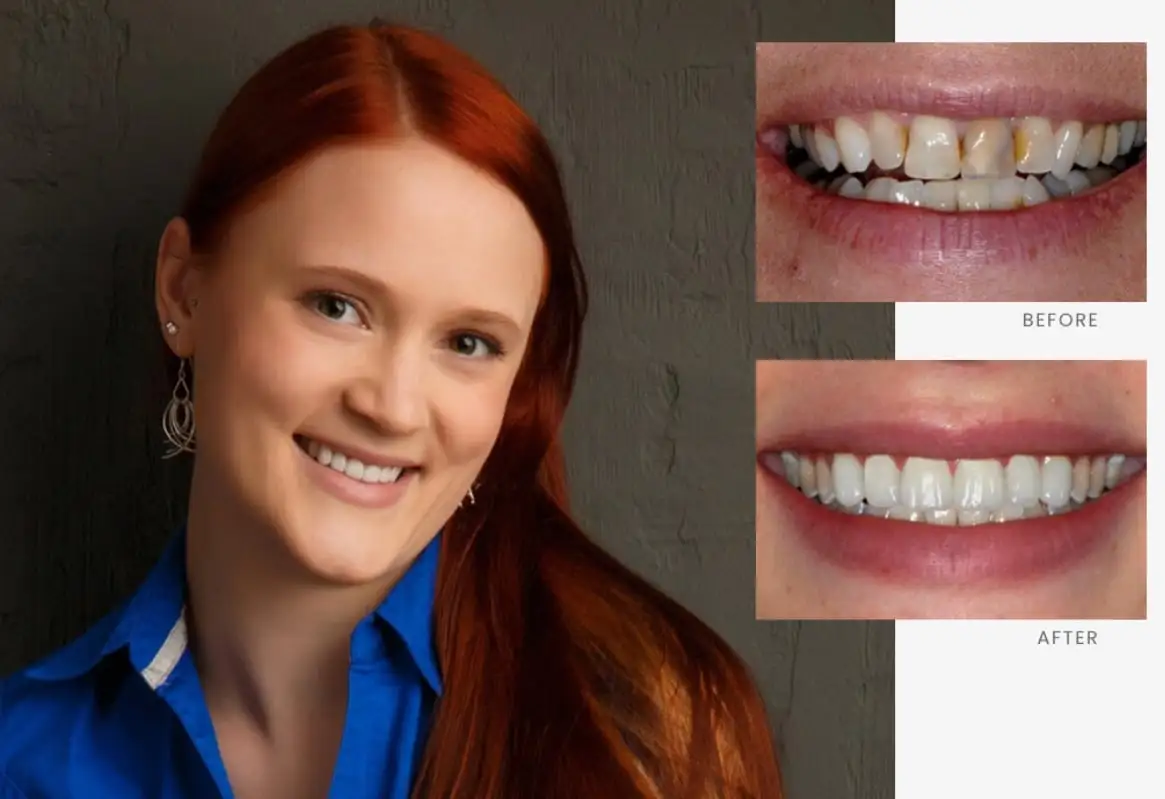 Stonebriar Smile Design patient case 5, before and after