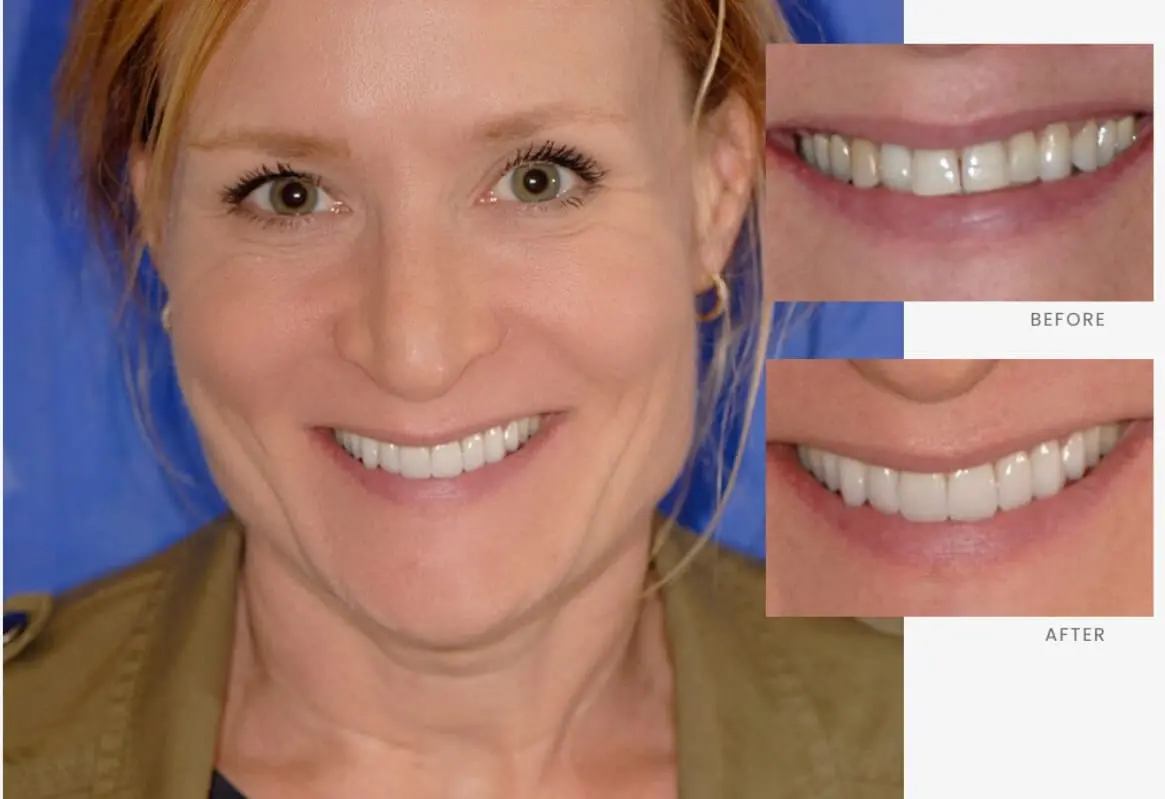 Stonebriar Smile Design patient case 6, before and after