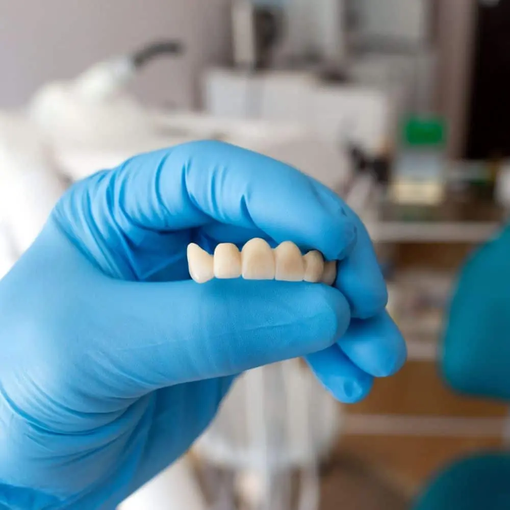 Dental bridge replacing a missing tooth between two supporting teeth
