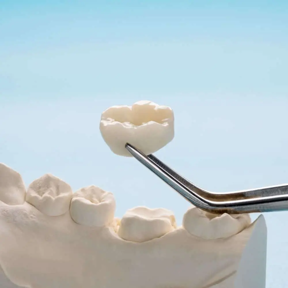 Porcelain crown shaped to fully cover and protect a tooth