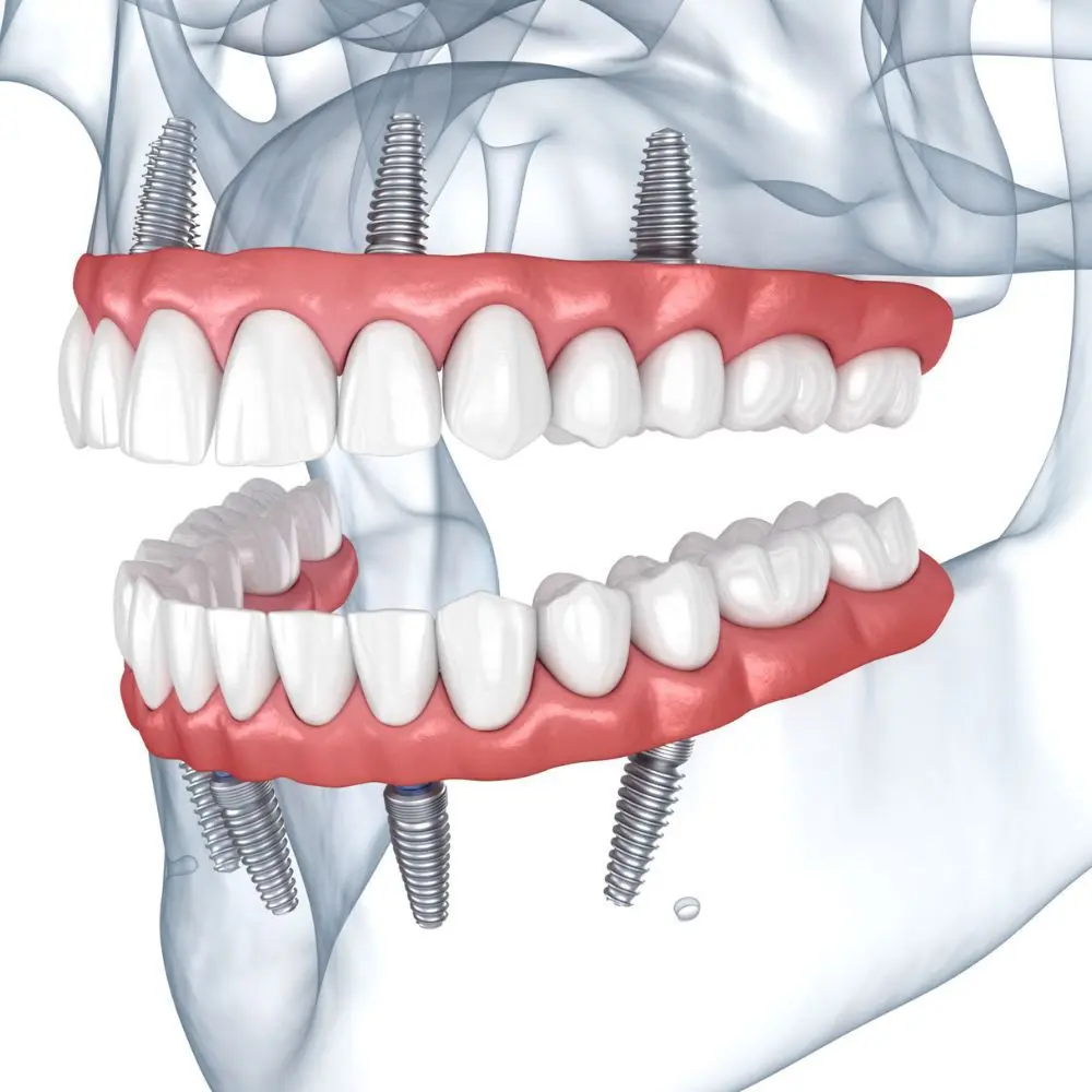 Full-arch implant treatment planned for a Stonebriar patient