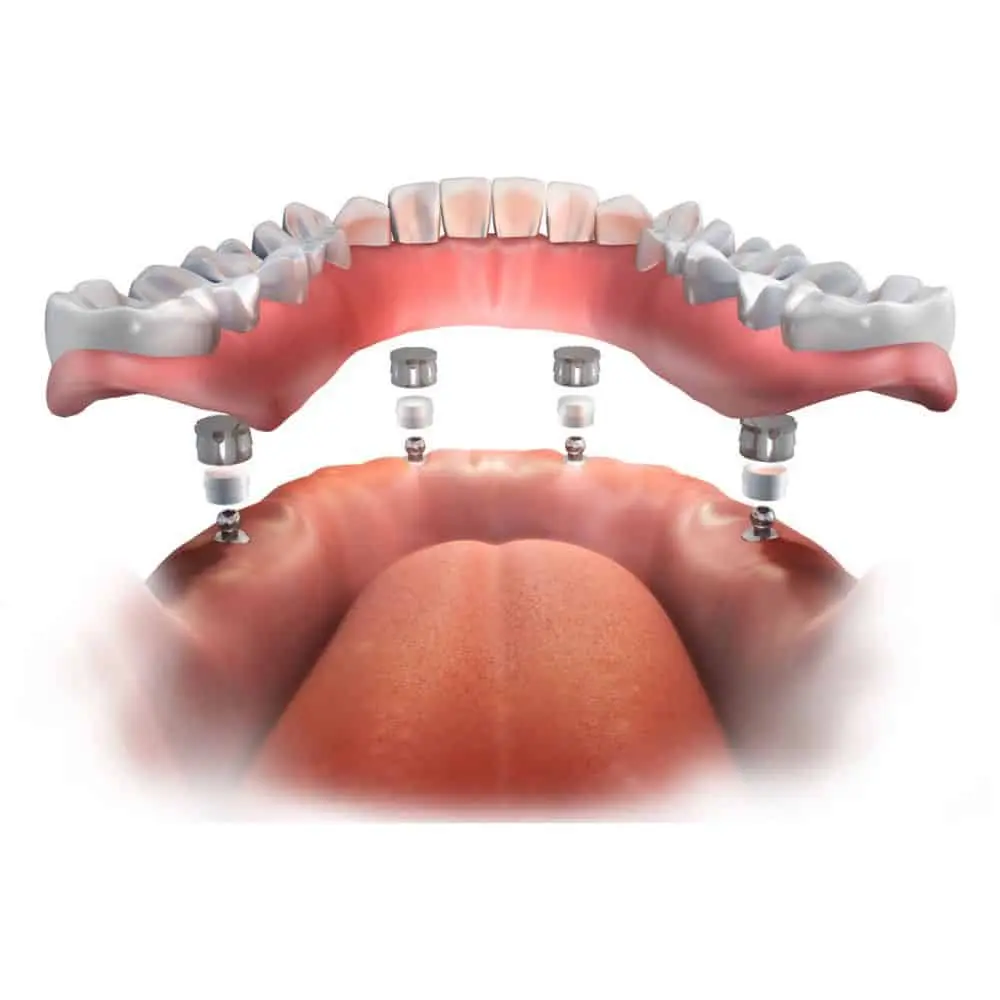 Dental implant treatment image illustrating full-arch restoration planning
