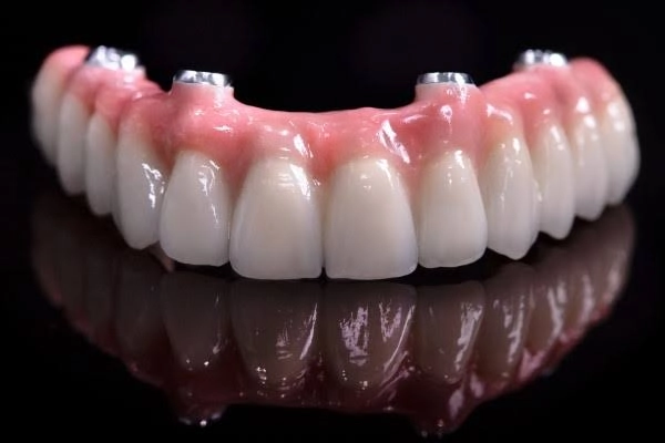 Implant-supported denture anchored securely in place