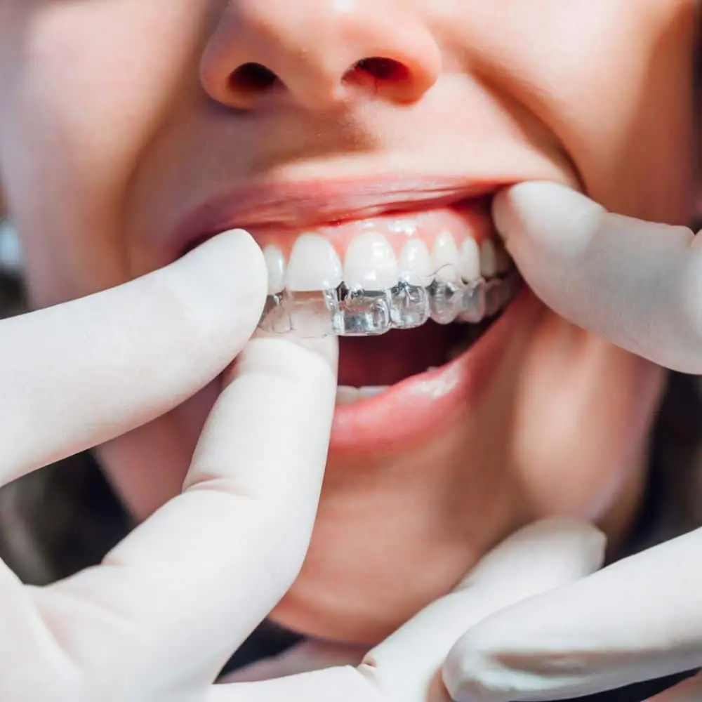 Clear Invisalign aligner positioned over a model of a patient’s teeth