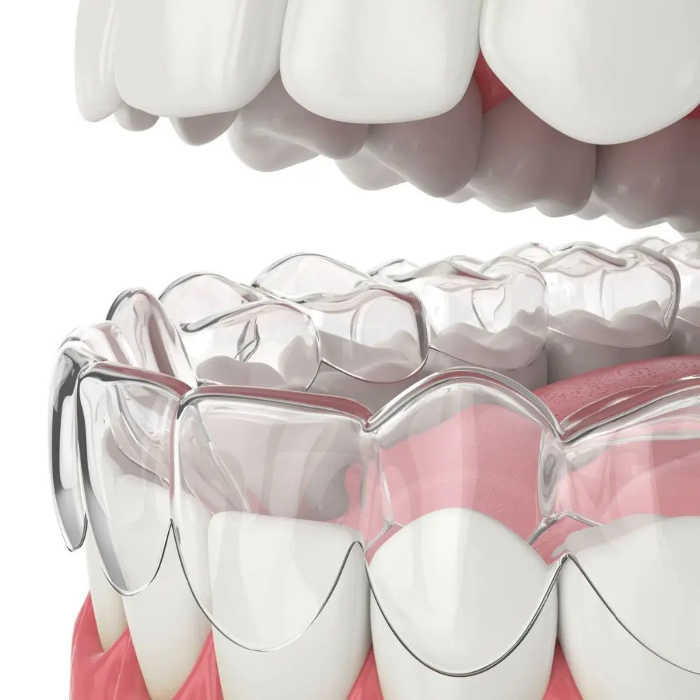 Patient smiling after completing clear aligner treatment