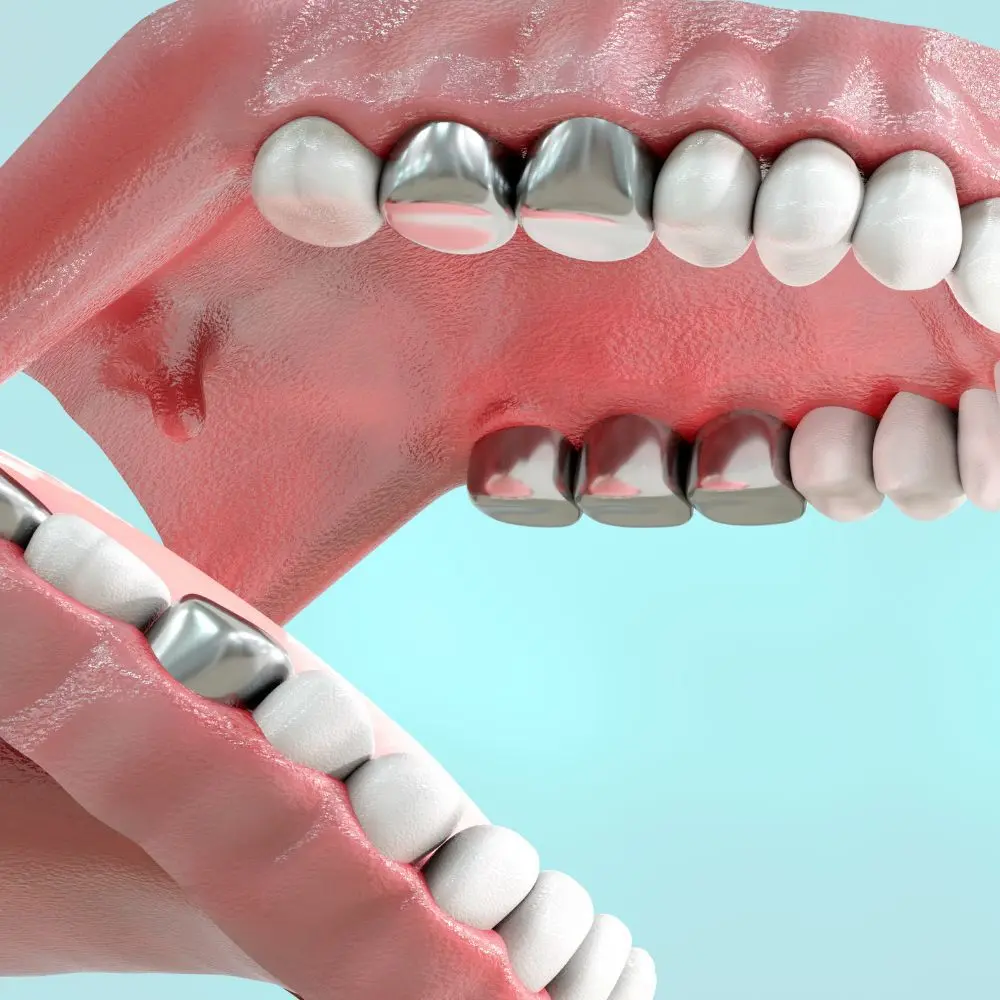 Dentist evaluating an older metal filling for possible replacement