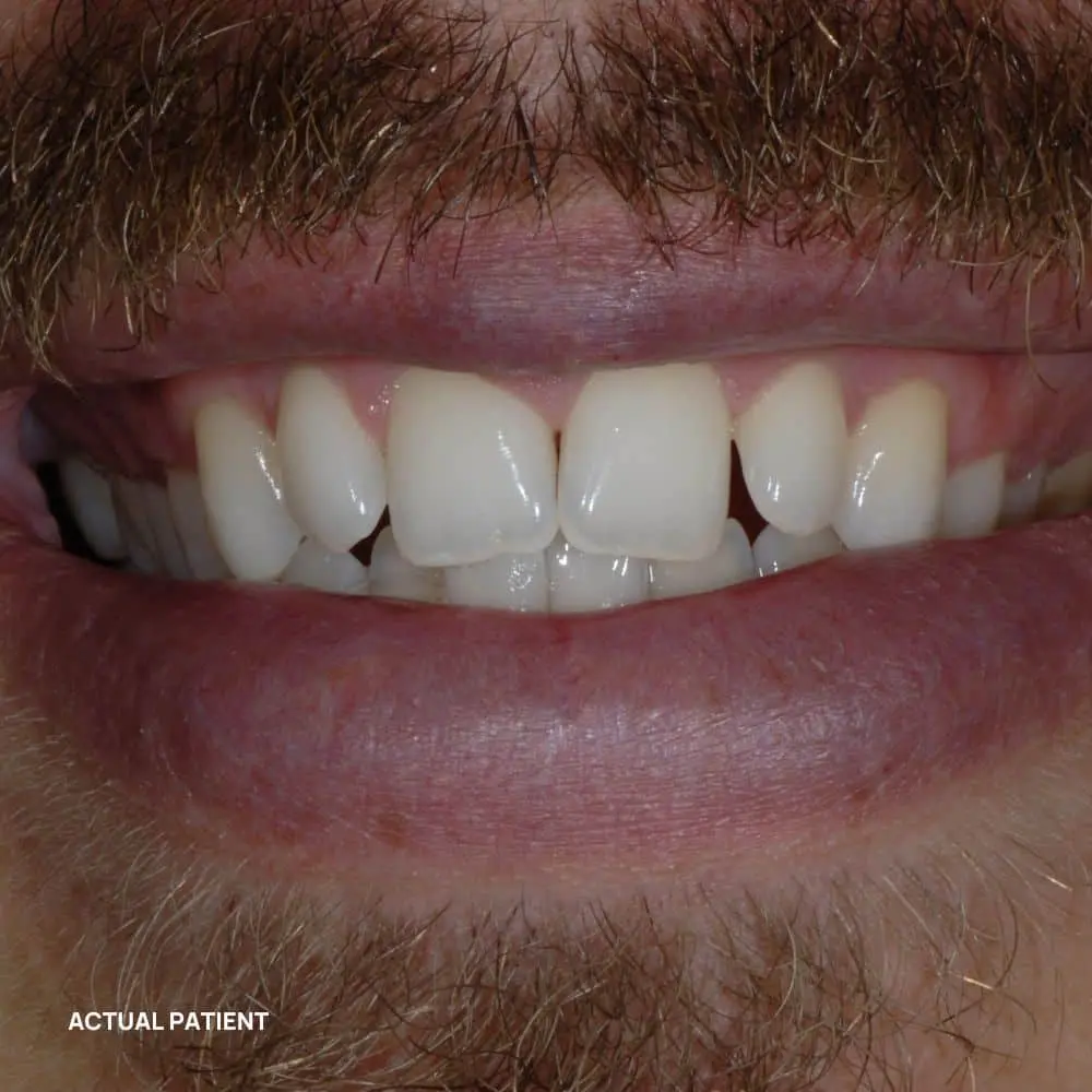 Smile before cosmetic treatment planning