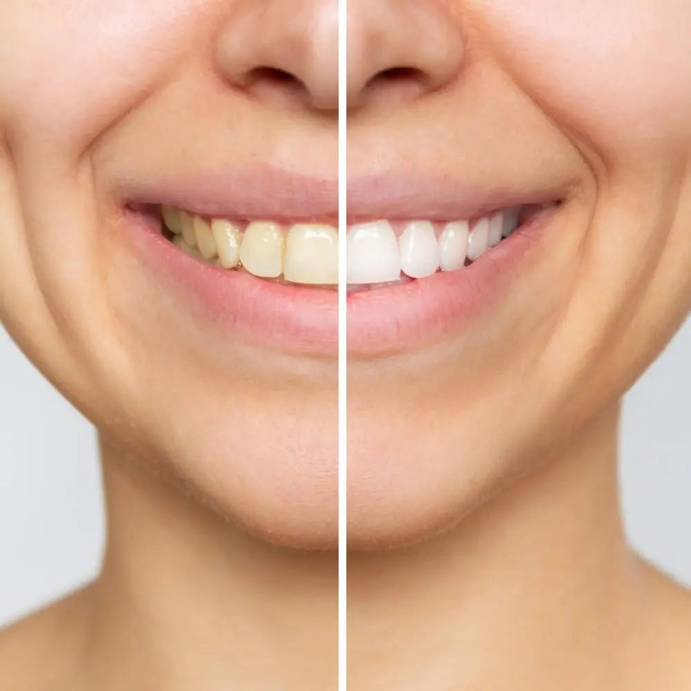 Bright smile following professional teeth whitening