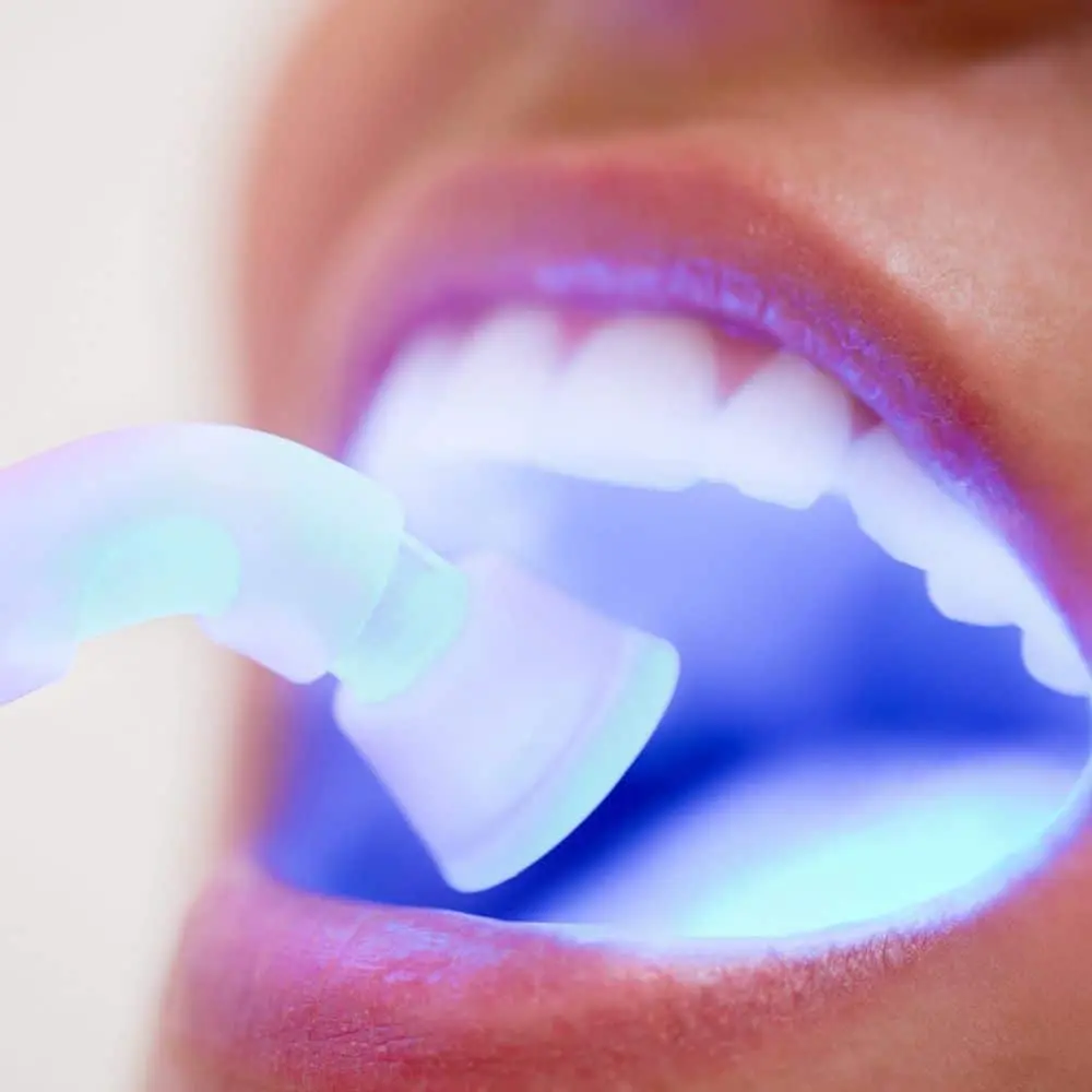 Composite resin filling matched to natural tooth enamel