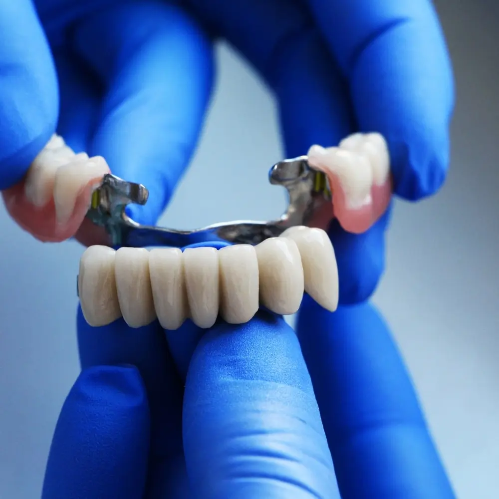 Dental bridge replacing consecutive missing teeth