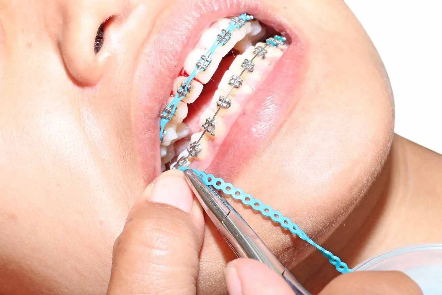 Patient having traditional braces adjusted