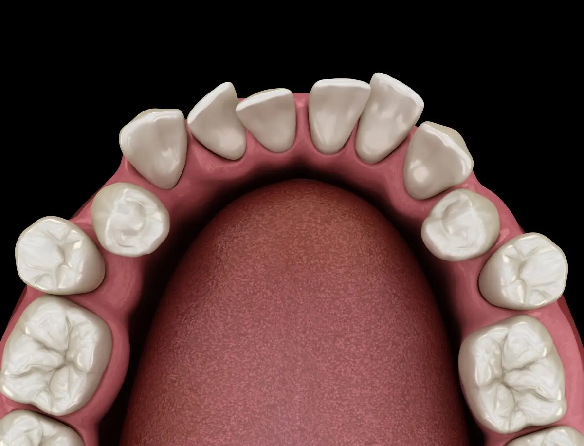 Dental illustration showing crowded and rotated teeth