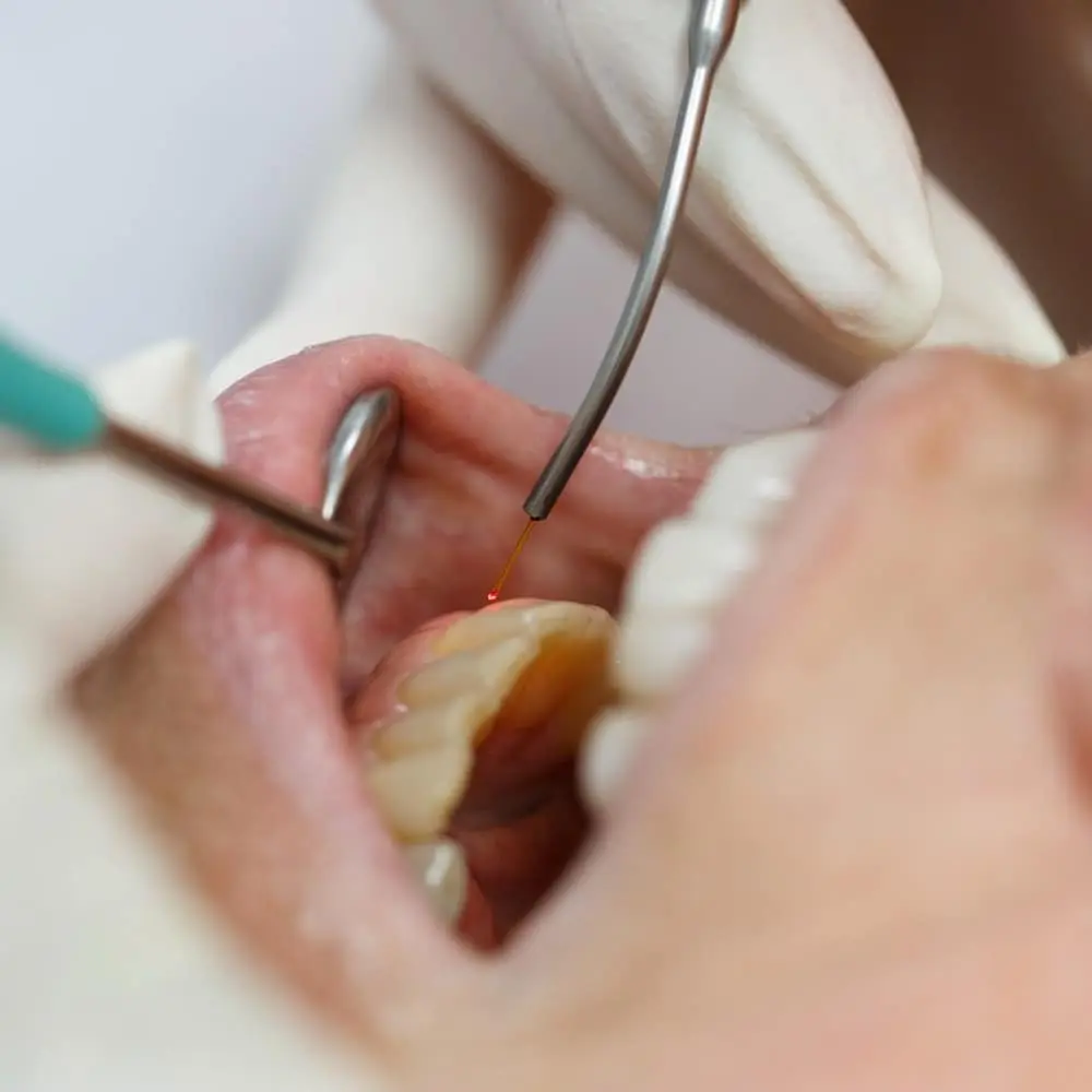 Waterlase laser used for precise periodontal treatment
